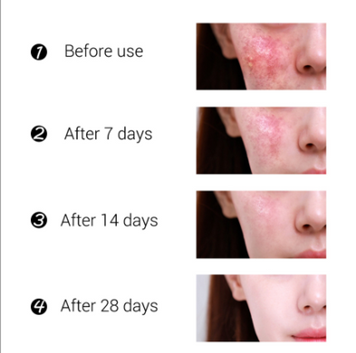 Крем для обличчя для догляду за проблемною та жирною шкірою проти акне (прищів) BREYLEE 20гр (201)